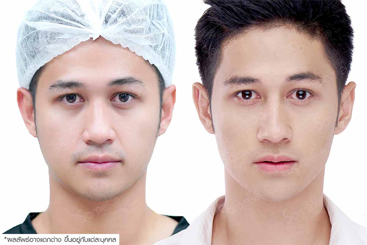เสริมจมูก คุณอ๊อด เสริมจมูก คุณอ๊อด