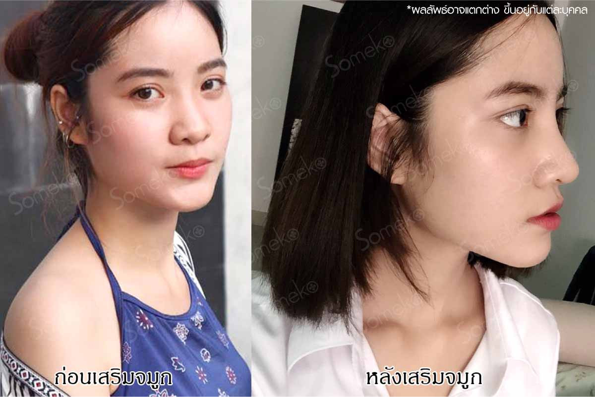 บอกลาดั้งแหมบ ด้วยการทำจมูก ที่ someko บอกลาดั้งแหมบ ด้วยการทำจมูก ที่ Someko