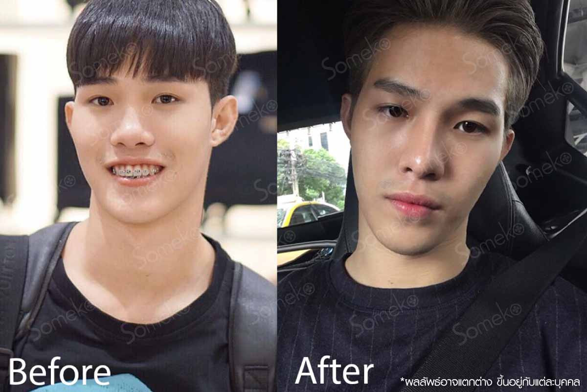 หน้าหล่อขึ้น แค่ทำจมูก หน้าหล่อขึ้น แค่ทำจมูก