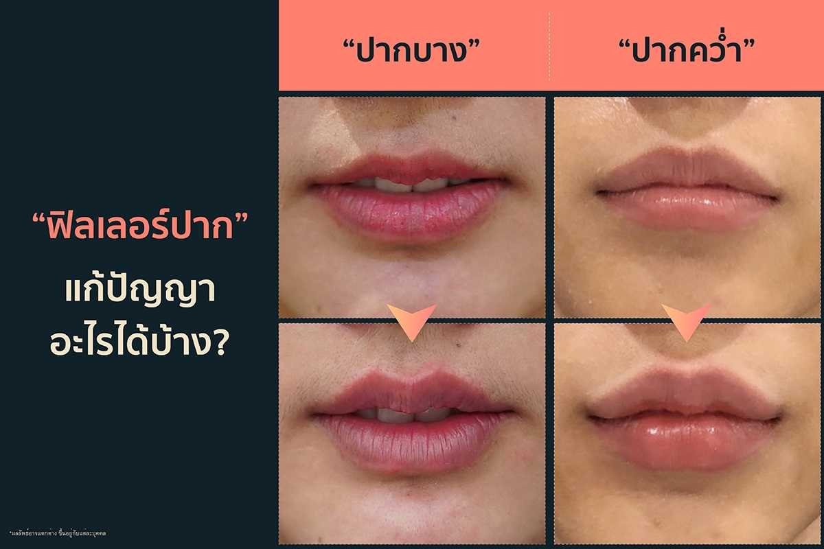 รูปทรงปากกระจับ