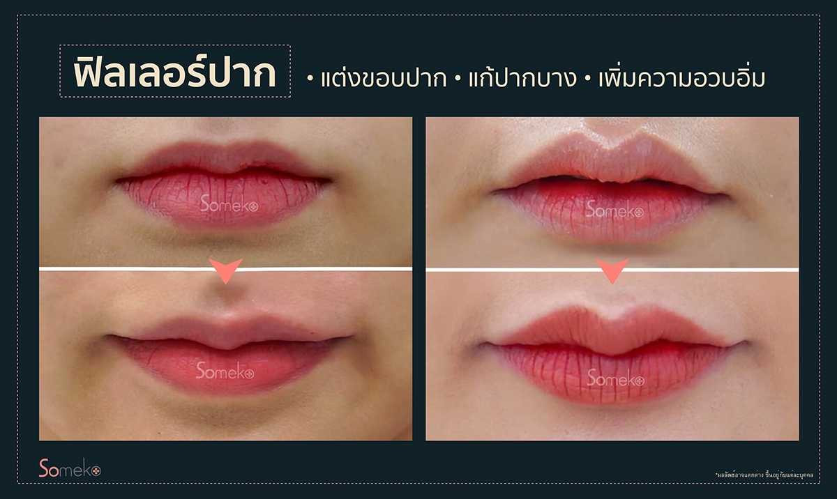 ฟิลเลอร์ปาก รีวิว