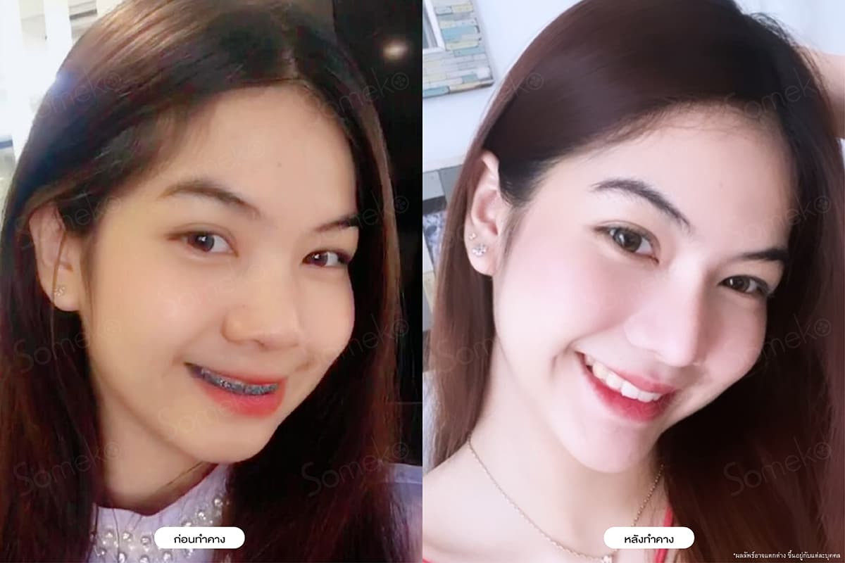 ไม่คิดว่าแค่เสริมคาง จะทำให้หน้าเปลี่ยนขนาดนี้! ไม่คิดว่าแค่เสริมคาง จะทำให้หน้าเปลี่ยนขนาดนี้!