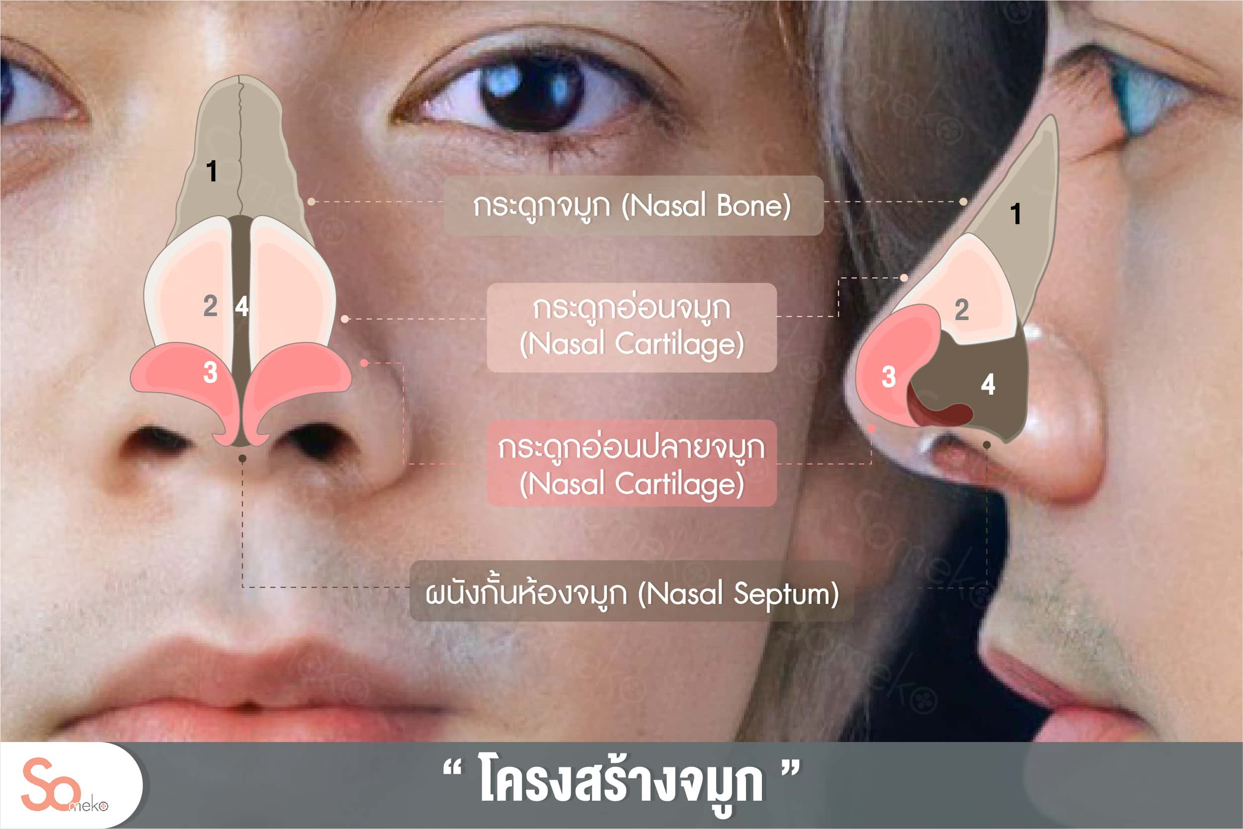 เสริมจมูกแบบโอเพ่น ข้อเสีย