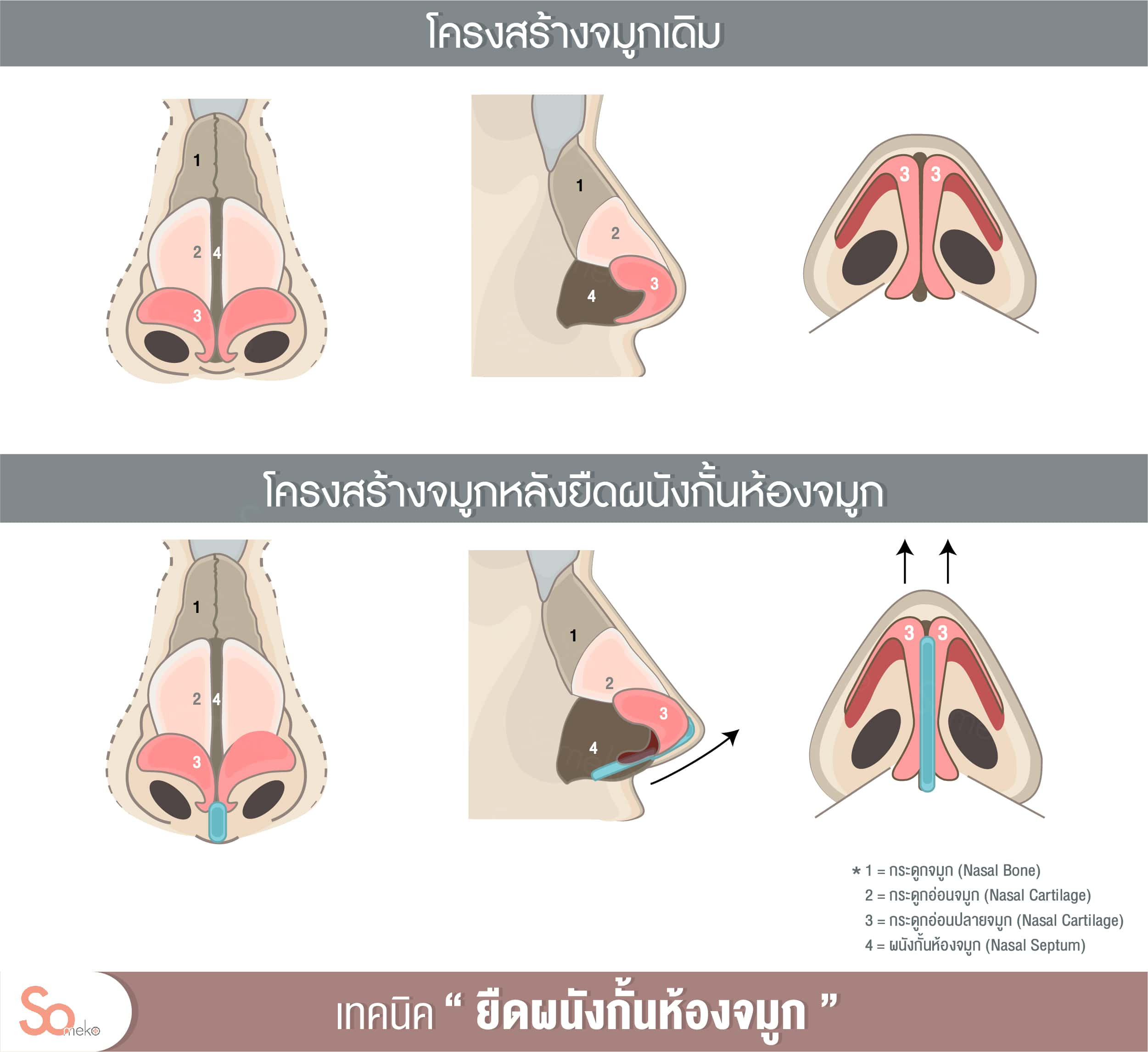 ทําจมูกแบบ open ราคา