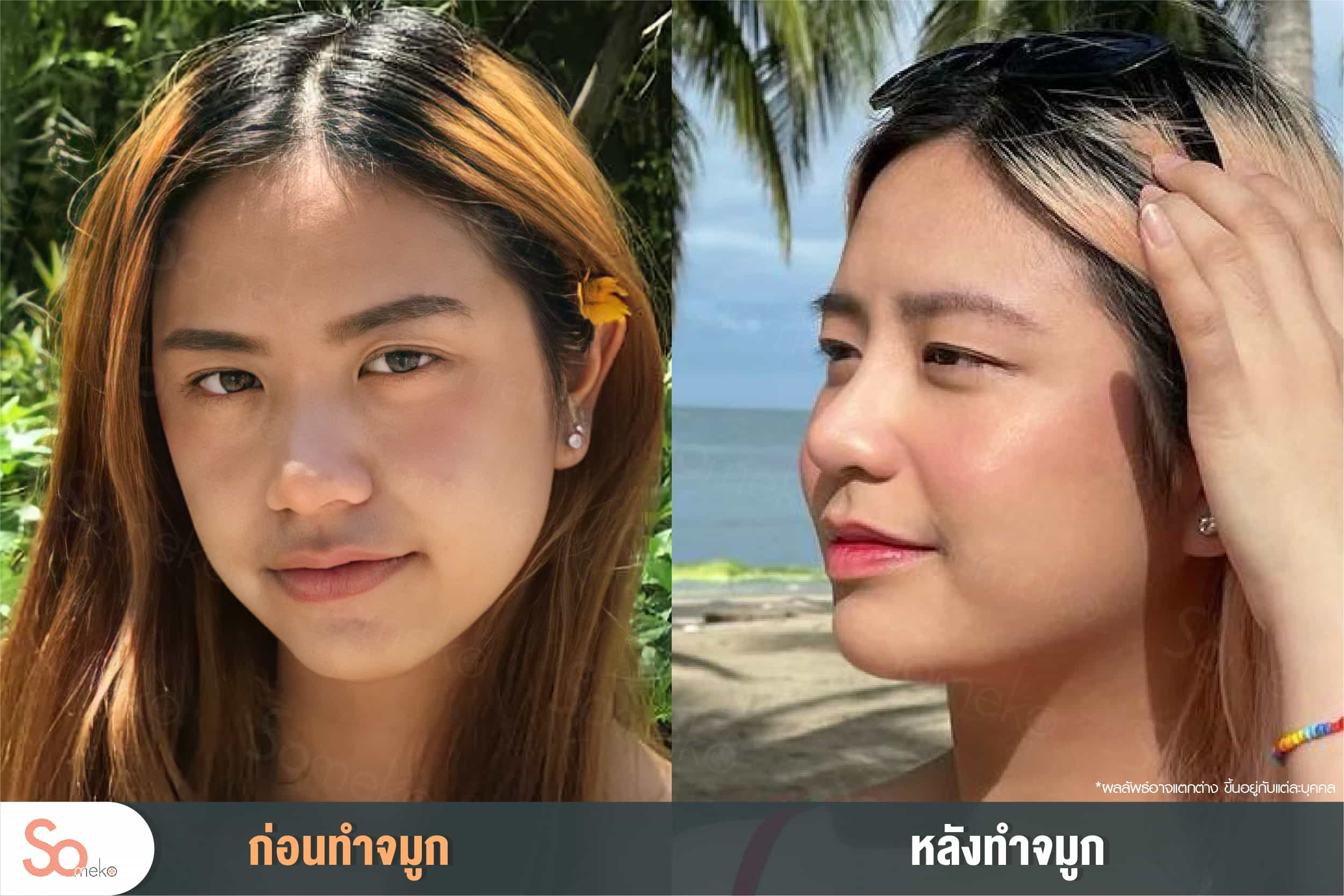 หลังเสริมจมูก